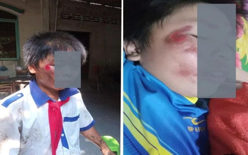 Tiền Giang: Công an thông tin vụ nam sinh lớp 6 bị trầy mặt
